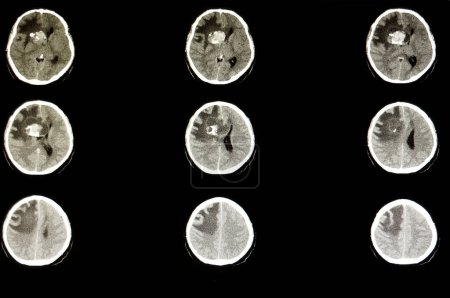 Foto de Radiografía del tumor cerebral en el fondo, primer plano - Imagen libre de derechos