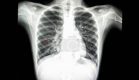 Foto de Neumonía pulmonar derecha radiografía de fondo, primer plano - Imagen libre de derechos