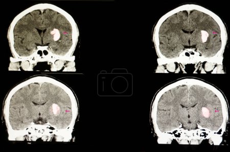 Téléchargez les photos : "un patient avec un grand hématome dans le cerveau" - en image libre de droit