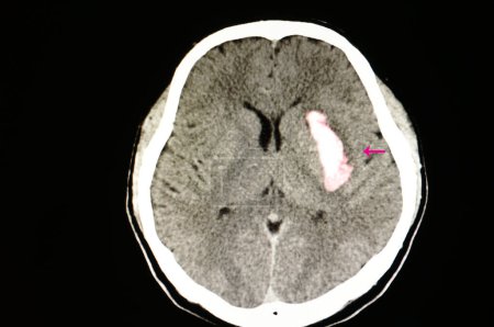 Téléchargez les photos : CT scan hémorragie intraventriculaire - en image libre de droit