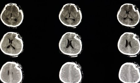 Foto de Fractura severa de depresión de una radiografía de cráneo en el fondo, primer plano - Imagen libre de derechos