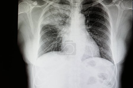Téléchargez les photos : "une pneumonie lobaire radiographie sur fond, gros plan - en image libre de droit