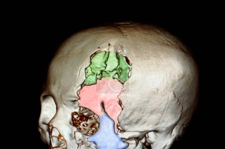 Foto de Cráneo fracturado severo, ilustración 3d - Imagen libre de derechos