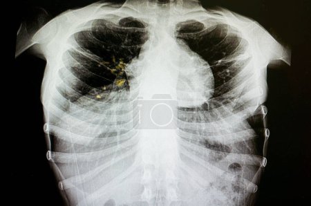 Téléchargez les photos : Tuberculose pulmonaire radiographie sur fond, gros plan - en image libre de droit