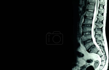 Téléchargez les photos : IRM des épines lombaires d'un patient souffrant de maux de dos chroniques - en image libre de droit
