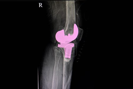 Téléchargez les photos : Arthroplastie totale du genou radiographie sur fond, gros plan - en image libre de droit
