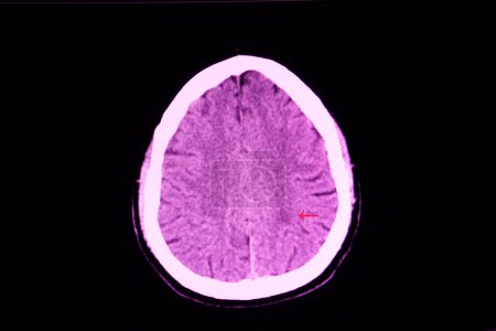 Foto de Infarto cerebral radiografía de fondo, primer plano - Imagen libre de derechos