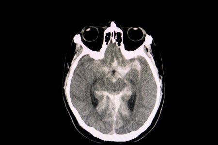 Foto de Radiografía de hemorragia subaracnoidea en el fondo, primer plano - Imagen libre de derechos