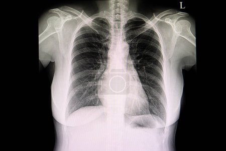 Foto de Radiografía de la válvula protésica en el fondo, primer plano - Imagen libre de derechos