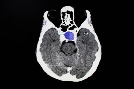 Téléchargez les photos : Tumeur piuitaire radiographie sur fond, gros plan - en image libre de droit