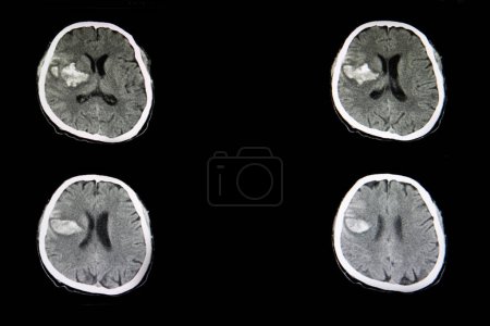 Téléchargez les photos : "CT scan of a brian of a patient with acute hemorrhagic stroke" - en image libre de droit