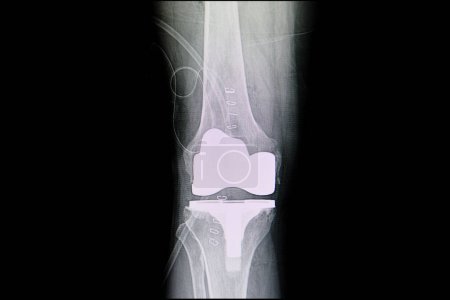 Photo for Total knee arthroplasty, x-ray scan - Royalty Free Image