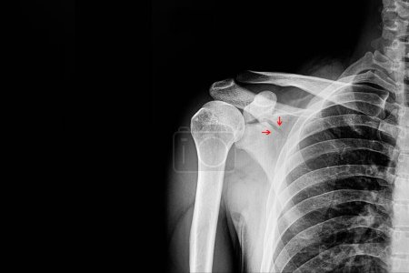 Foto de Escapulario de fractura, escáner de rayos X - Imagen libre de derechos