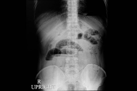 Téléchargez les photos : Film radiographique abdominal d'un patient présentant une obstruction de l'intestin grêle - en image libre de droit