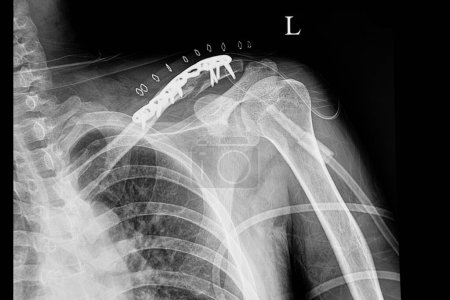 Téléchargez les photos : Une radiographie de film d'épaule d'un patient avec clavicule fracturée - en image libre de droit