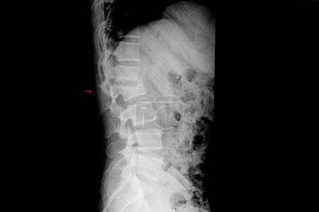 Foto de Radiografía de un paciente que muestra fractura por compresión de lambar - Imagen libre de derechos