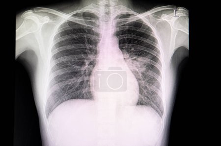 Téléchargez les photos : Pneumopathie, radiographie - en image libre de droit