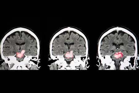 Photo for Brain stem hemorrhage, x-ray scan - Royalty Free Image