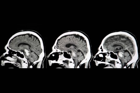 Foto de Hemorragia del tronco encefálico, exploración por rayos X - Imagen libre de derechos