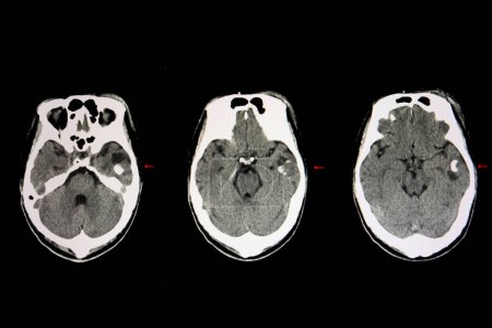 Foto de Tumor cerebral quístico, radiografía - Imagen libre de derechos