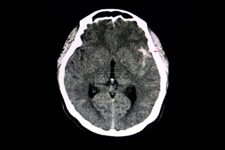 Foto de Aneurisma fracturado del cerebro por TC, exploración por rayos X - Imagen libre de derechos