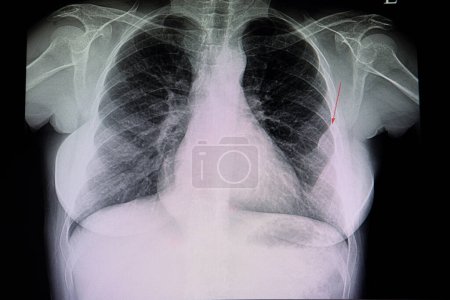 Foto de Una lesión pleural, una radiografía - Imagen libre de derechos