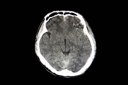 Photo for CT brain scan of a patient with bilateral hemorrhagic contusion, x-ray scan - Royalty Free Image
