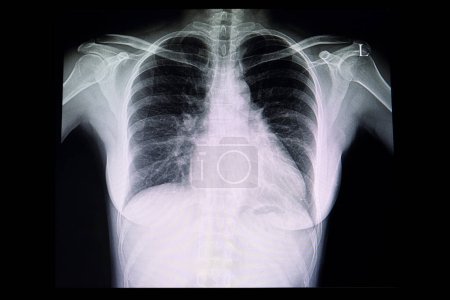Photo for Chest x ray film of a patient with cardiomegaly - Royalty Free Image