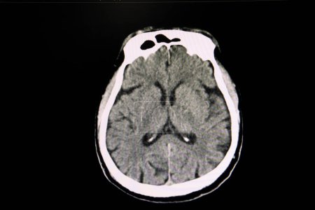 Téléchargez les photos : Atrophie cérébrale, radiographie - en image libre de droit