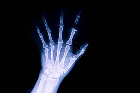 Téléchargez les photos : Amputation traumatique du doigt, radiographie - en image libre de droit