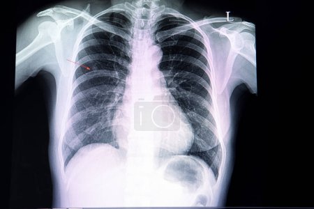 Foto de Nódulo pequeño en el pulmón, exploración por rayos X - Imagen libre de derechos