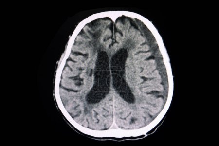 Foto de Hematoma subdural subagudo cerebral por TC, exploración por rayos X - Imagen libre de derechos