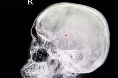Téléchargez les photos : Fracture du crâne, radiographie - en image libre de droit