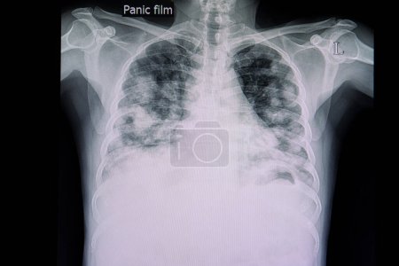 Foto de Carcinoma metastásico de los pulmones, radiografía - Imagen libre de derechos