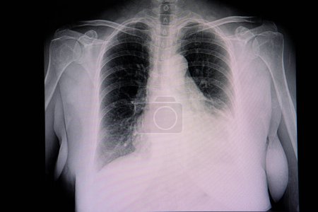 Téléchargez les photos : Cardiomégalie et épanchement pleural gauche, radiographie - en image libre de droit