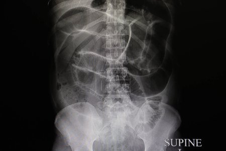 Foto de Obstrucción intestinal, radiografía - Imagen libre de derechos