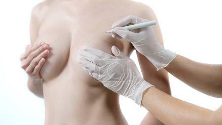 Téléchargez les photos : Ligne de dessin à la main du médecin sur le sein de la femme, chirurgie d'implant mammaire - en image libre de droit