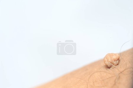 Foto de Etiqueta cutánea de masa pedunculada o acrocondón o fibroma blando. Golpe de papiloma en macro cuerpo masculino disparo en el muslo - Imagen libre de derechos