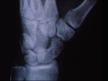 Photo for Hand root bone after accident in x-ray image - Royalty Free Image