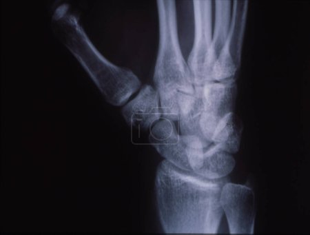 Foto de Hueso de la raíz de la mano después de accidente en imagen de rayos X - Imagen libre de derechos
