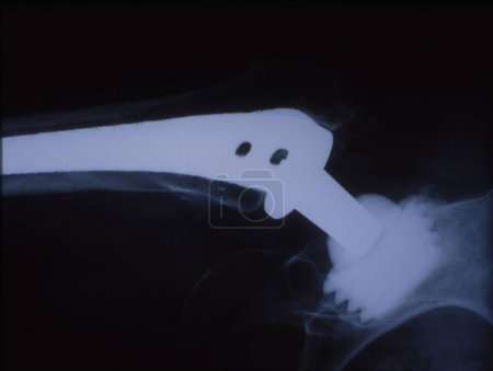 Foto de Artificial hip joint en la imagen de rayos X del muslo humano - Imagen libre de derechos