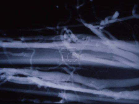 Photo for Leg veins as varicose veins in the X-ray - Royalty Free Image