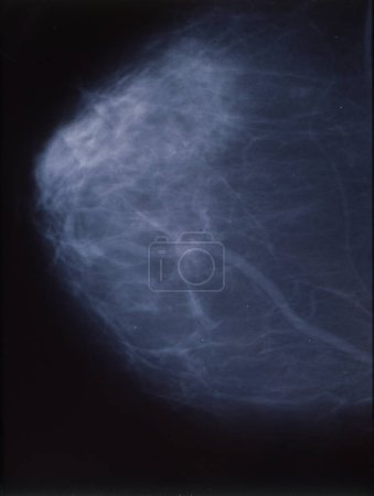 Foto de Radiografía como mamografía de la mama femenina - Imagen libre de derechos
