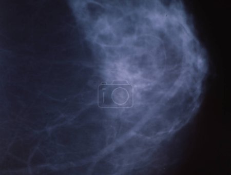 Foto de Radiografía como mamografía de la mama femenina - Imagen libre de derechos