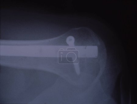 Photo for Arm bone with nail after accident in the X-ray image - Royalty Free Image