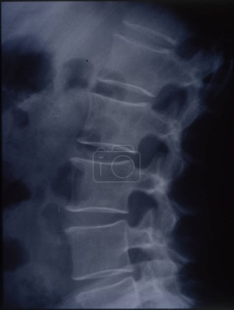 Téléchargez les photos : Image radiographique de la colonne vertébrale pour le diagnostic médical - en image libre de droit