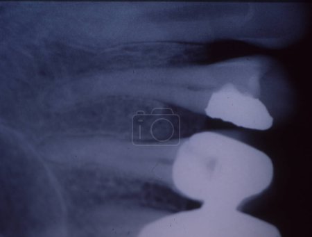 Photo for X-ray image of teeth with fillings and bridges - Royalty Free Image