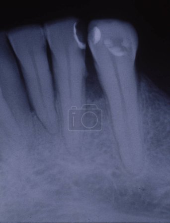 Téléchargez les photos : Image radiographique des dents avec obturations et ponts - en image libre de droit