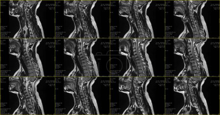 Téléchargez les photos : Ensemble d'IRM sagittales de la région du cou d'un homme caucasien de 34 ans avec extrusion bilatérale paramédiale du segment C6-C7 avec radiculopathie - en image libre de droit