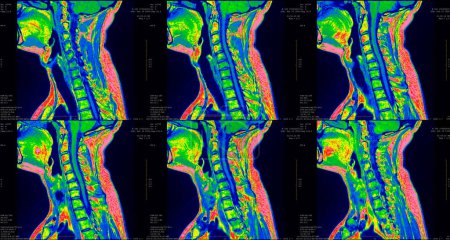 Photo for Set of 6 sagittal green colored MRI scans of neck area of caucasian 34 years old male with bilateral paramedial extrusion of the C6-C7 segment - Royalty Free Image